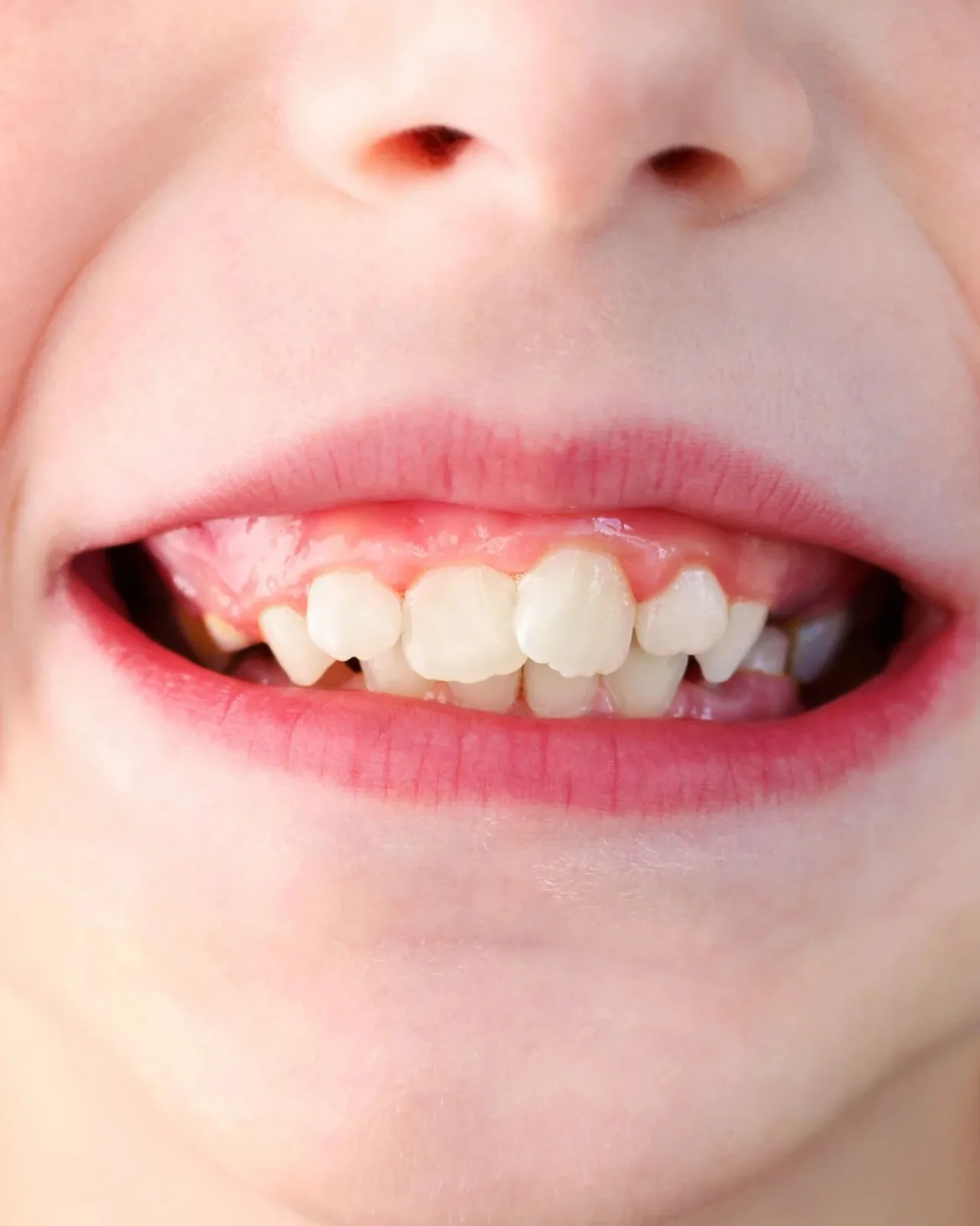 Dents qui se chevauchent chez l'enfant : signe à surveiller en orthodontie